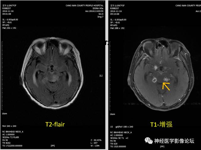 【PPT】颅内结核