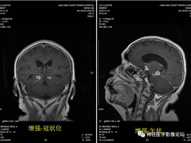 【PPT】颅内结核