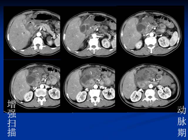 【病例】腹部炎性肌纤维母细胞瘤1例CT