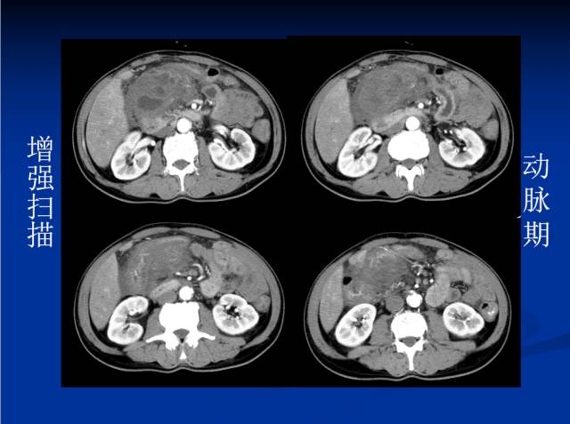 【病例】腹部炎性肌纤维母细胞瘤1例CT