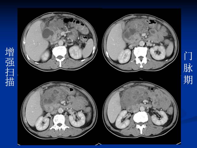 【病例】腹部炎性肌纤维母细胞瘤1例CT
