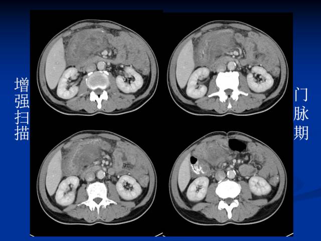 【病例】腹部炎性肌纤维母细胞瘤1例CT