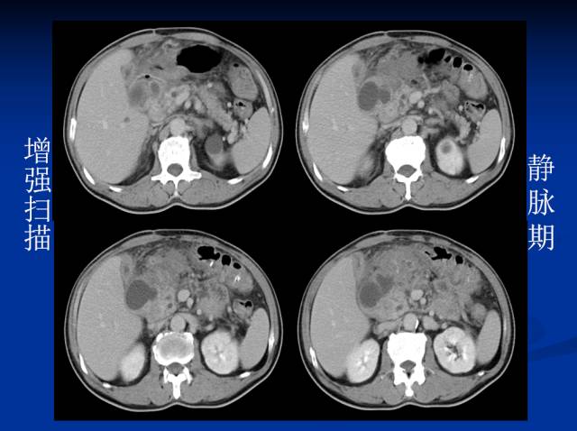 【病例】腹部炎性肌纤维母细胞瘤1例CT