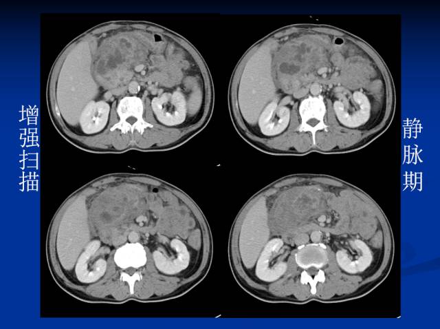 【病例】腹部炎性肌纤维母细胞瘤1例CT