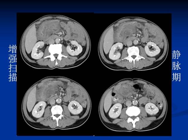 【病例】腹部炎性肌纤维母细胞瘤1例CT