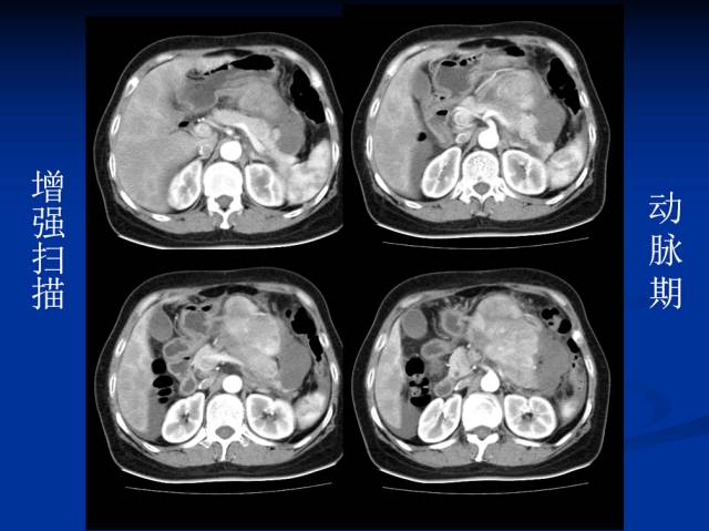 【病例】腹部炎性肌纤维母细胞瘤1例CT