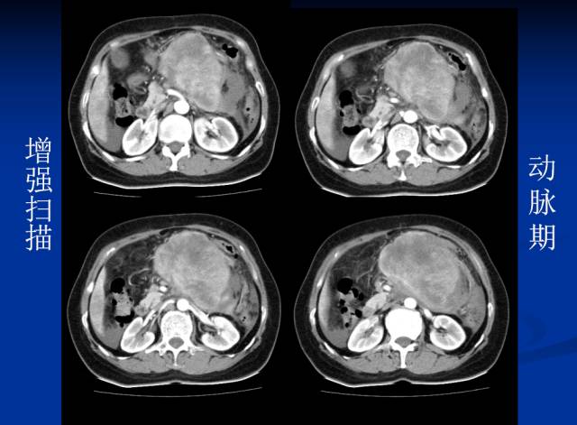 【病例】腹部炎性肌纤维母细胞瘤1例CT