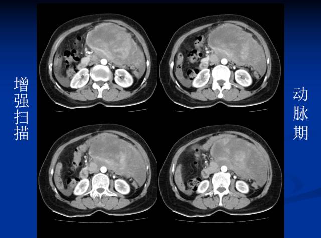 【病例】腹部炎性肌纤维母细胞瘤1例CT