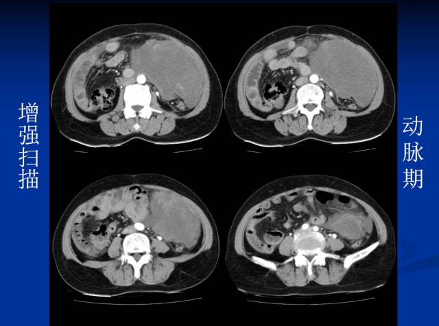 【病例】腹部炎性肌纤维母细胞瘤1例CT