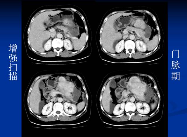 【病例】腹部炎性肌纤维母细胞瘤1例CT
