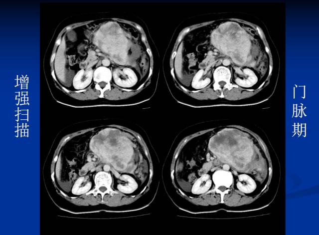 【病例】腹部炎性肌纤维母细胞瘤1例CT