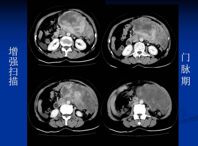 【病例】腹部炎性肌纤维母细胞瘤1例CT