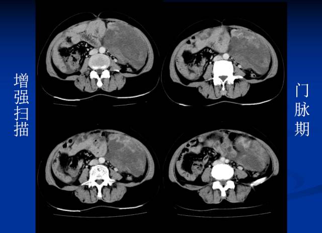 【病例】腹部炎性肌纤维母细胞瘤1例CT