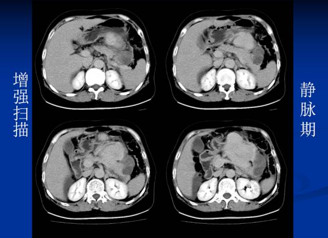 【病例】腹部炎性肌纤维母细胞瘤1例CT