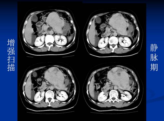 【病例】腹部炎性肌纤维母细胞瘤1例CT