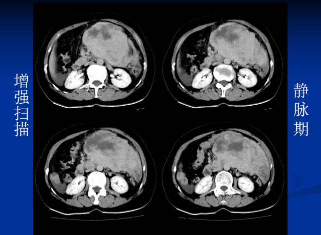 【病例】腹部炎性肌纤维母细胞瘤1例CT