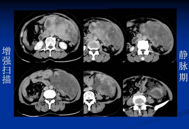 【病例】腹部炎性肌纤维母细胞瘤1例CT