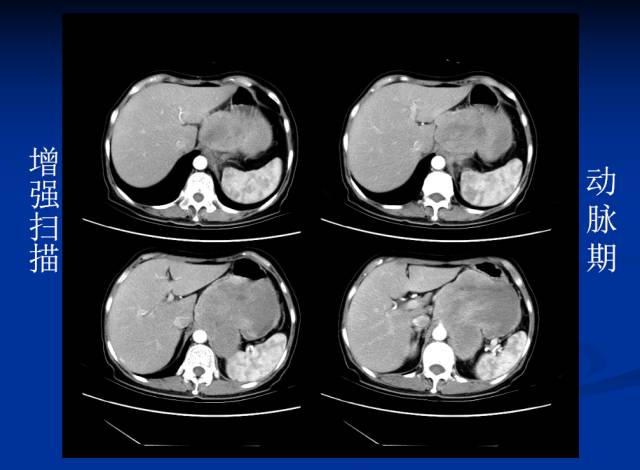 【病例】腹部炎性肌纤维母细胞瘤1例CT