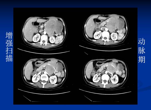 【病例】腹部炎性肌纤维母细胞瘤1例CT