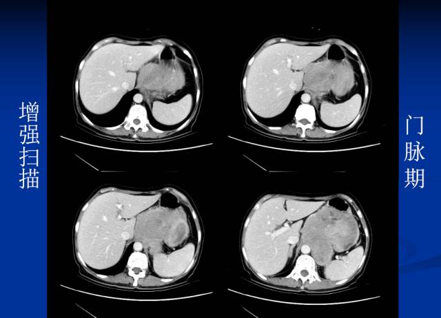【病例】腹部炎性肌纤维母细胞瘤1例CT