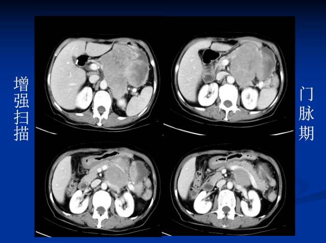 【病例】腹部炎性肌纤维母细胞瘤1例CT