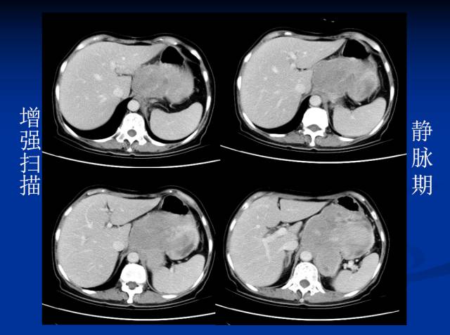 【病例】腹部炎性肌纤维母细胞瘤1例CT