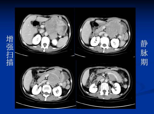 【病例】腹部炎性肌纤维母细胞瘤1例CT