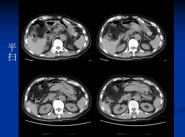 【病例】腹部炎性肌纤维母细胞瘤1例CT