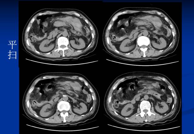 【病例】腹部炎性肌纤维母细胞瘤1例CT