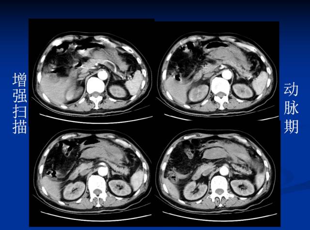 【病例】腹部炎性肌纤维母细胞瘤1例CT