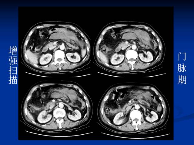 【病例】腹部炎性肌纤维母细胞瘤1例CT
