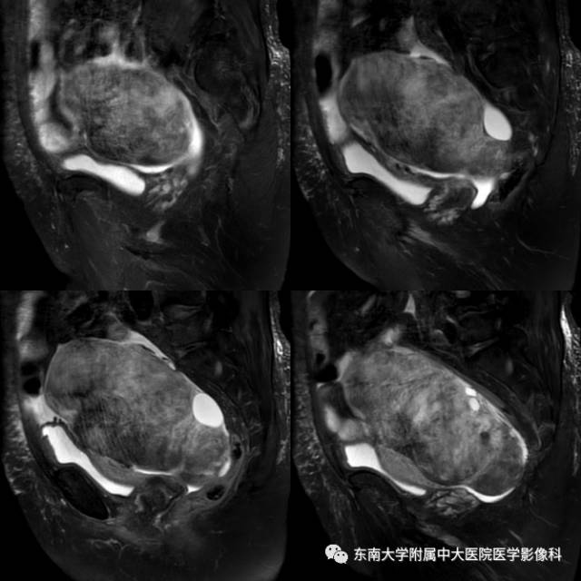 【病例】卵泡膜细胞-纤维瘤1例MR