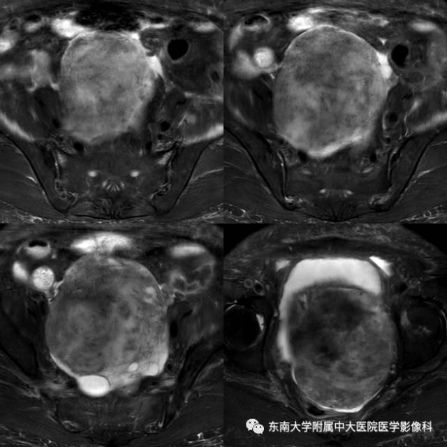 【病例】卵泡膜细胞-纤维瘤1例MR