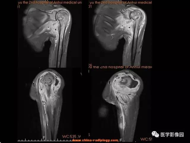 【病例】软骨母细胞瘤1例X线CT及MR