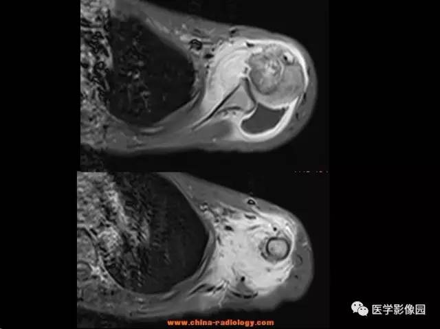 【病例】软骨母细胞瘤1例X线CT及MR