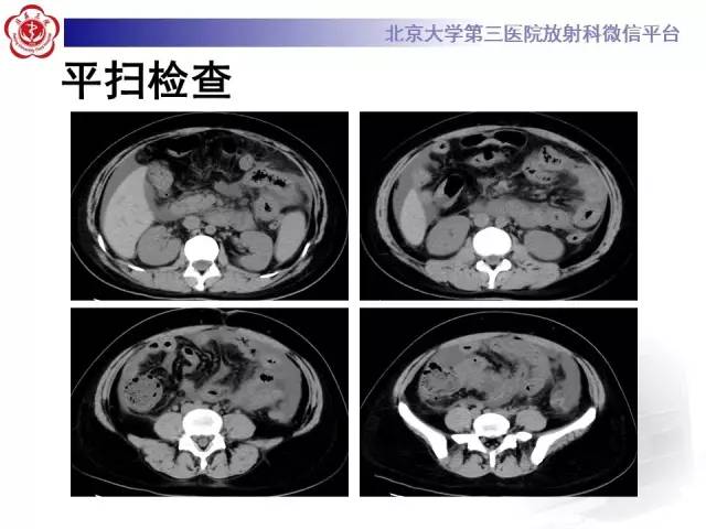 【病例】嗜酸细胞性胃肠炎1例CT