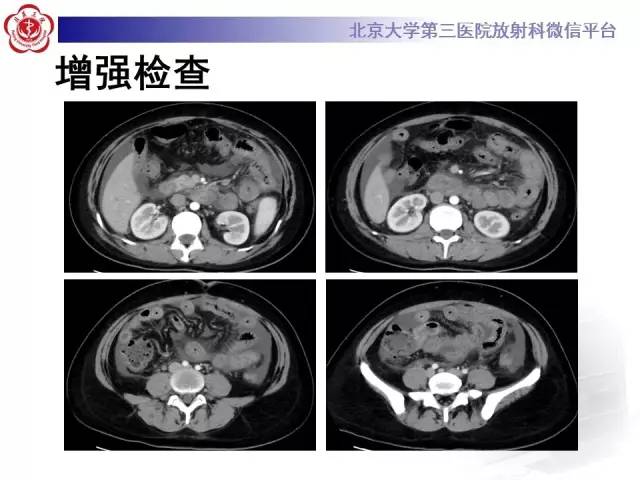 【病例】嗜酸细胞性胃肠炎1例CT