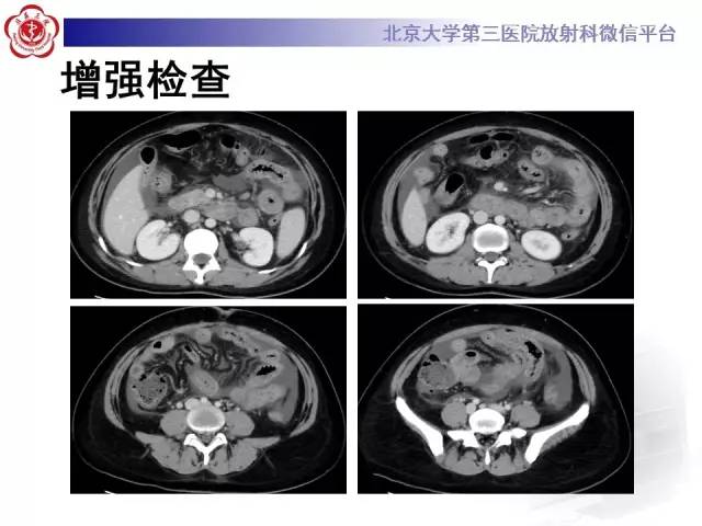【病例】嗜酸细胞性胃肠炎1例CT