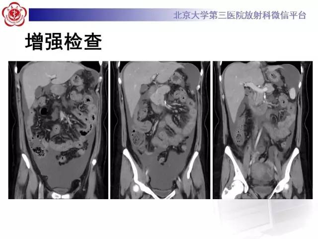 【病例】嗜酸细胞性胃肠炎1例CT