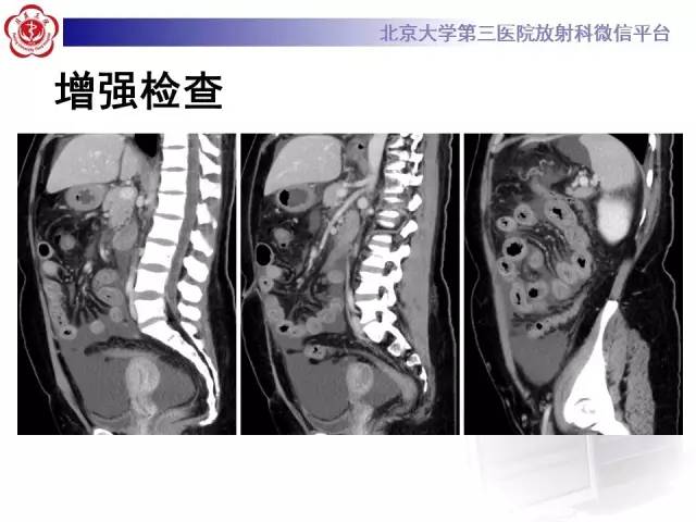【病例】嗜酸细胞性胃肠炎1例CT