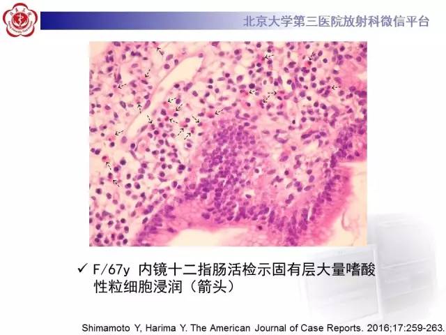 【病例】嗜酸细胞性胃肠炎1例CT