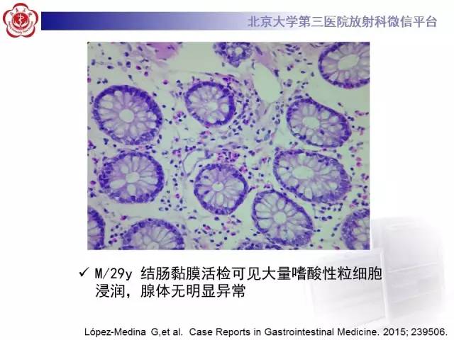 【病例】嗜酸细胞性胃肠炎1例CT