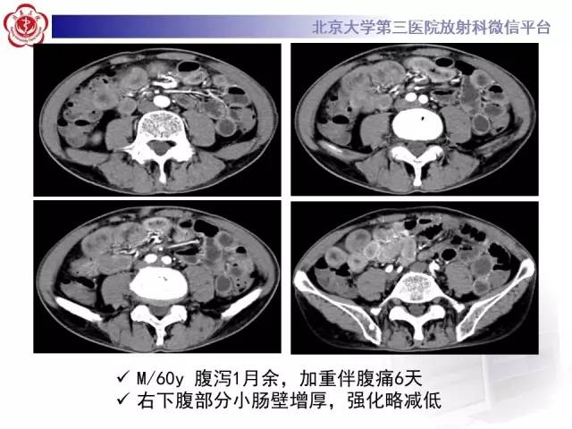 【病例】嗜酸细胞性胃肠炎1例CT