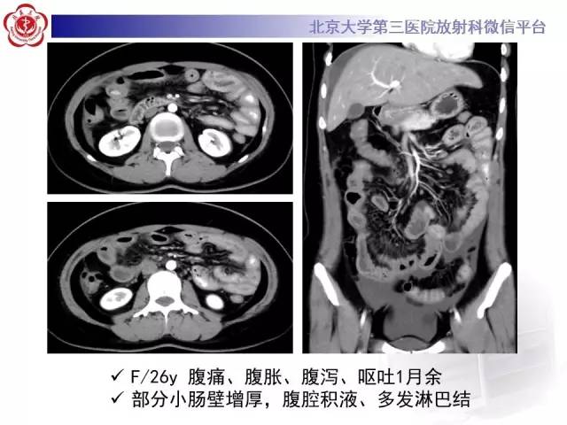 【病例】嗜酸细胞性胃肠炎1例CT