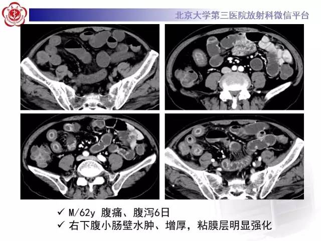 【病例】嗜酸细胞性胃肠炎1例CT