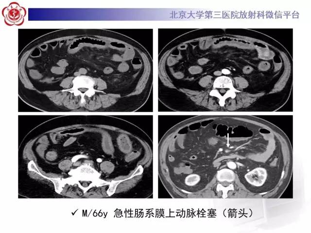 【病例】嗜酸细胞性胃肠炎1例CT