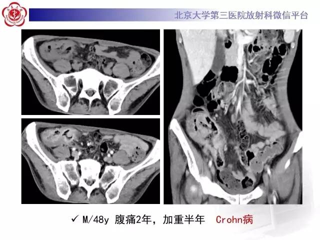 【病例】嗜酸细胞性胃肠炎1例CT