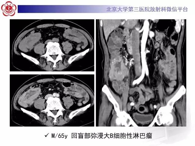 【病例】嗜酸细胞性胃肠炎1例CT