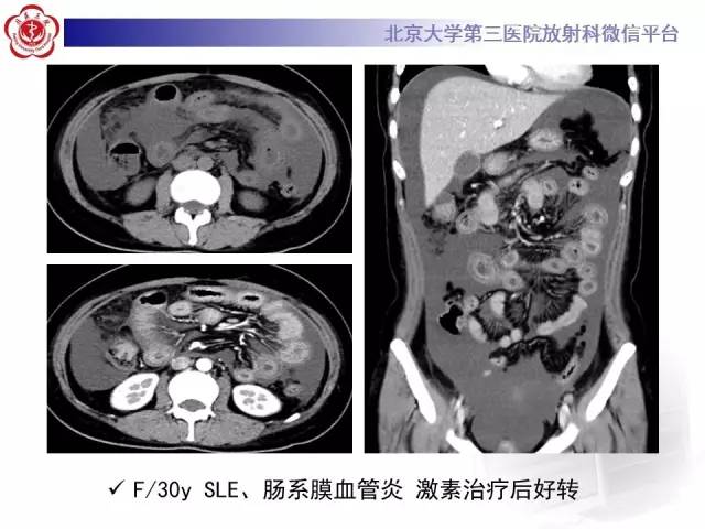 【病例】嗜酸细胞性胃肠炎1例CT