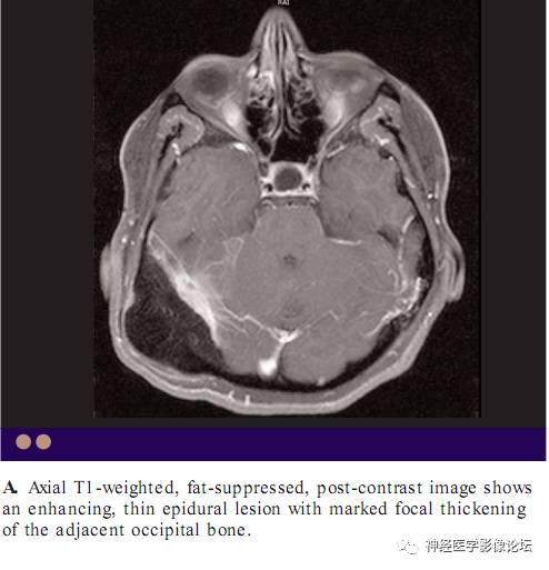 Skull Thickness Skull Thickness